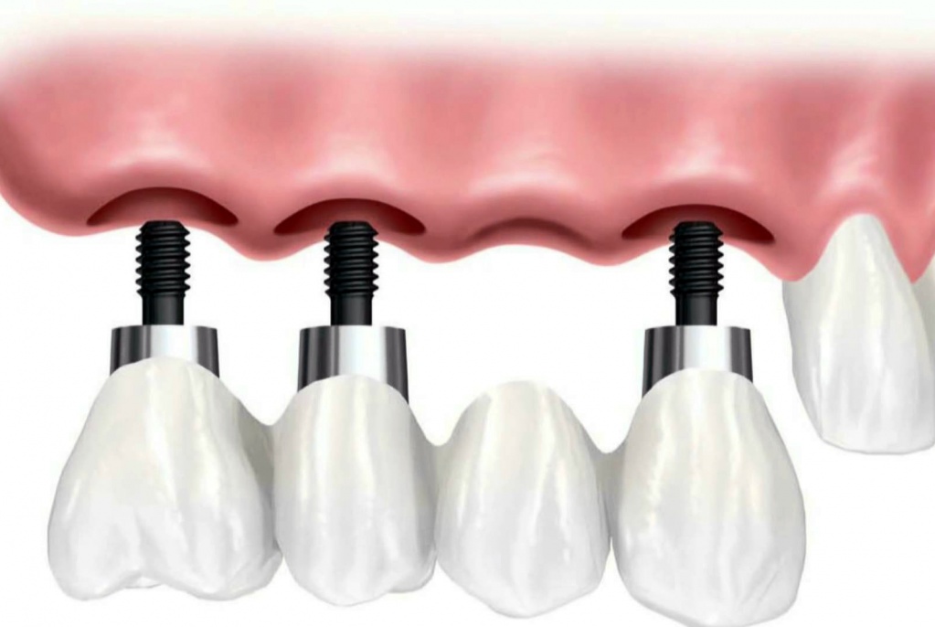 protezirovanie-zubov-v-ylyanovske-5.jpg